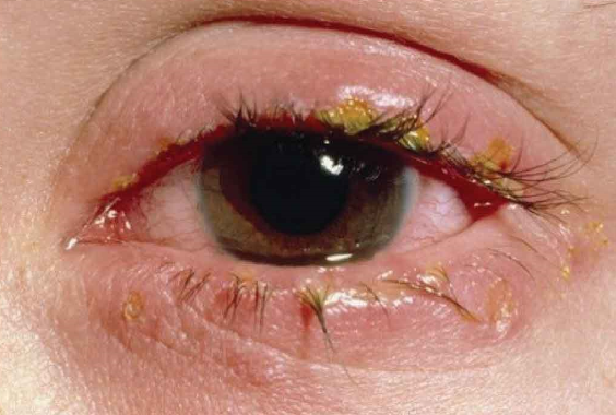 các bệnh do nguồn nước ô nhiễm gây nên